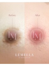 エルビービュティーサロン(LB BEAUTY SALON)/【ルメラ乳輪】実績数関西1★