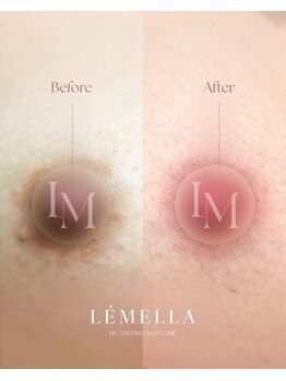 エルビービュティーサロン(LB BEAUTY SALON)/【ルメラ乳輪】実績数関西1★