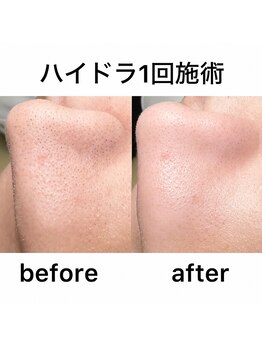 ブロッサム 天神 春吉(Blossom)の写真/鏡を見るたび気になる毛穴、もう諦めなくていい。黒ずみ・開き・詰まりに本気でアプローチします！！