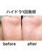 ブロッサム 天神 春吉(Blossom)の写真/鏡を見るたび気になる毛穴、もう諦めなくていい。黒ずみ・開き・詰まりに本気でアプローチします！！