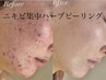 【ニキビ改善】くり返すニキビを根本改善 ハーブピーリング+生酵素300種