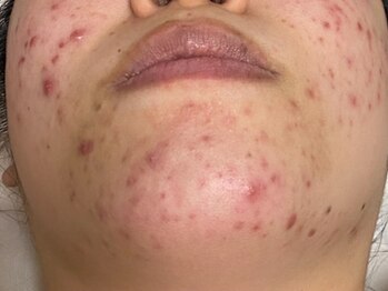 スキンケアスタジオ アコ 新宿店(Aco)/GPソフト１Dのお客様