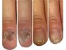 女性限定【深爪矯正/噛み爪】 爪が弱く綺麗に伸ばせない方に12000→8800