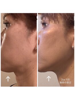 スパフランコルシャン(Spa Francorchamps)/レモンボトルのビフォーアフター