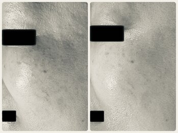 エフェクト 塚口店(effect)/Before After 40代/2回目