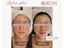 パルタージュ 三宮(Partage)/ニキビも少なくします