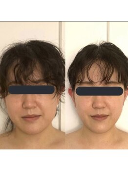 ハイコガオ 中崎町店(HIKOGAO)/小顔矯正