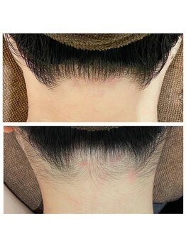 ミース 北九州店/うなじ◇ビフォーアフター