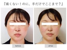 エピファニー(Epiphany)/20代　左右差と大きさが悩みで…