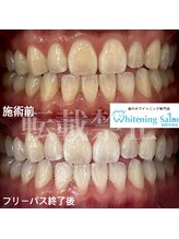 ホワイトニングサロン 福岡天神店/ホワイトニング