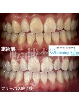 ホワイトニングサロン 福岡天神店/ホワイトニング