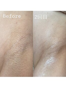 白美/ダクトでワキの黒ずみピーリング