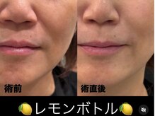 ビューティーサロン リリー(Lily)/《ほうれい線・たるみケア》