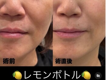 ビューティーサロン リリー(Lily)/《ほうれい線・たるみケア》