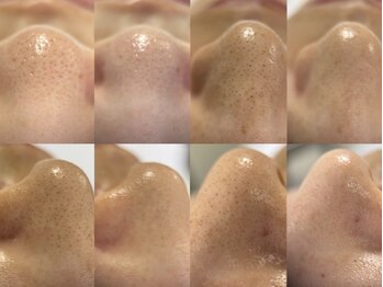 フェリス(FELIZ)の写真/《毛穴レスキュー参上》夏直前!その毛穴どうする?隠せない季節始まってます☆手遅れ前に夏肌リセット◎