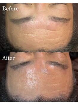 POLITE MENS EYEBROWの写真/【徹底肌質改善】ハーブピーリング×プラズマシャワー★頑固な毛穴詰まり・ニキビ肌荒れを根本ケア！