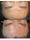 POLITE MENS EYEBROWの写真/【徹底肌質改善】ハーブピーリング×プラズマシャワー★頑固な毛穴詰まり・ニキビ肌荒れを根本ケア！