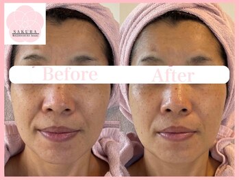 サクラ(SAKURA)/50代お顔もスッキリ