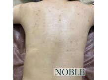 ノーブル 新宿南口(NOBLE)/背中ハーブピーリングNOBLE