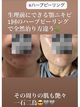 リツイート(ReTweet)/ハーブピーリング・艶・くすみ