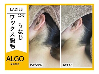 アルゴ 南茨木駅前店(ALGO)/【うなじ脱毛】