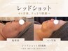  【二重あご・顔脂肪】レッドショット×プラズマでVライン小顔 60分