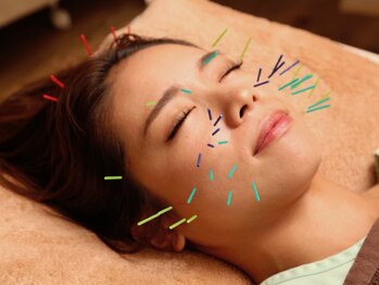 ハリス(HARIS)/鍼を打ち終わるとこんな感じ