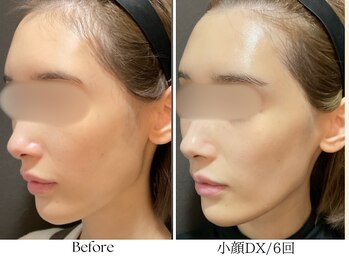 ビボーラ(BEBEAURA)/2週間に1回のスリムDX