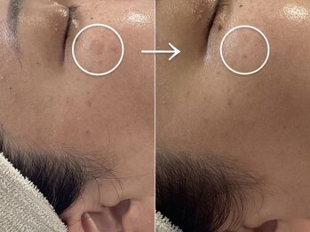 リベルテ(LIBERTE)/30代のシミケア