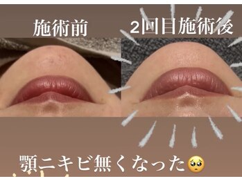 リツイート(ReTweet)/ハーブピーリング・艶・くすみ