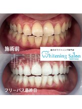 ホワイトニングサロン 福岡天神店/ホワイトニング