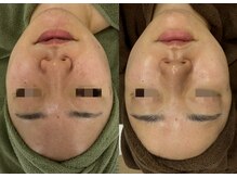 レイ(Lei)/毛穴/ニキビ/ハーブピーリング