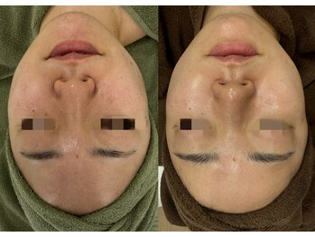 レイ(Lei)/毛穴/ニキビ/ハーブピーリング