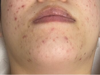 スキンケアスタジオ アコ 新宿店(Aco)/GPソフト１Dのお客様1ヶ月後