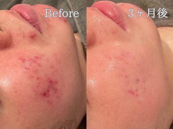 ポポラス(POPOLUS)/ニキビケア×プロテイン　3ヶ月