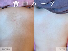 レヴェリー 心斎橋店(REVERIE)/ブライダル | お背中ハーブ