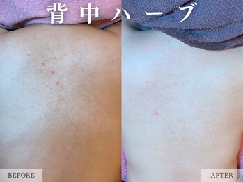 レヴェリー 心斎橋店(REVERIE)/ブライダル | お背中ハーブ