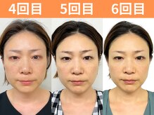 ナチュラルビューティーフェイス 横浜(NBF)/小顔矯正/ビフォーアフター