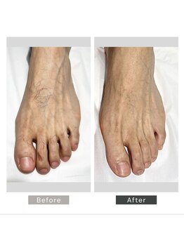 シーボウ(CBOU)/美容電気脱毛(指の毛)