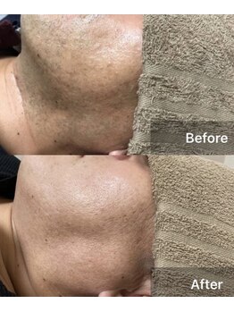 エヌプラス(N plus+)/メンズも脱毛の時代！