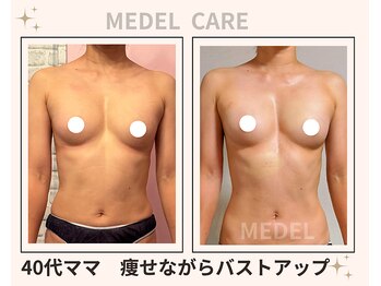 メデル 北千住店/バストアップ*育乳症例