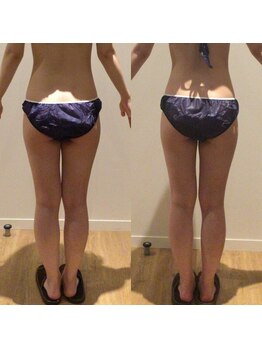 アユアランリンク 札幌店/20代後半/1ヵ月半/下半身/側面