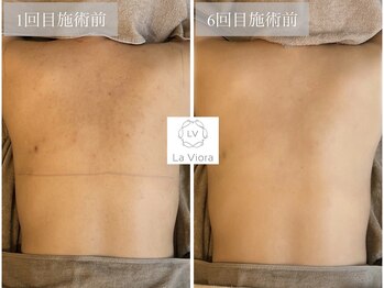 ラヴィオーラ 福島野田店(La Viora)/ダイヤモンドハーブピーリング