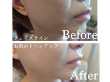 サロンドエステ ルヴニール(salon de esthe revenir)の雰囲気（１度の施術でここまで激変！しわ改善/トーンアップに◎）