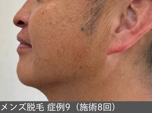 オアシスラグーン(OASIS LAGOON)/メンズ脱毛（症例9 施術8回）
