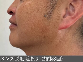 オアシスラグーン(OASIS LAGOON)/メンズ脱毛(症例9 施術8回)