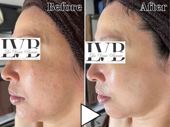 ラヴレボーテ(La Vraie Beaute)/40代・敏感赤み・改善期間2カ月