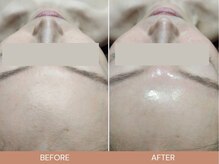 脱毛サロン ベル(Bell)/肌育ララピール★セラピール