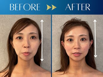 シンク 表参道(CINQ)/美容鍼灸60分1回の変化