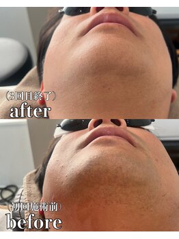 ミーエイト(Mii∞)/《ヒゲBefore/After》